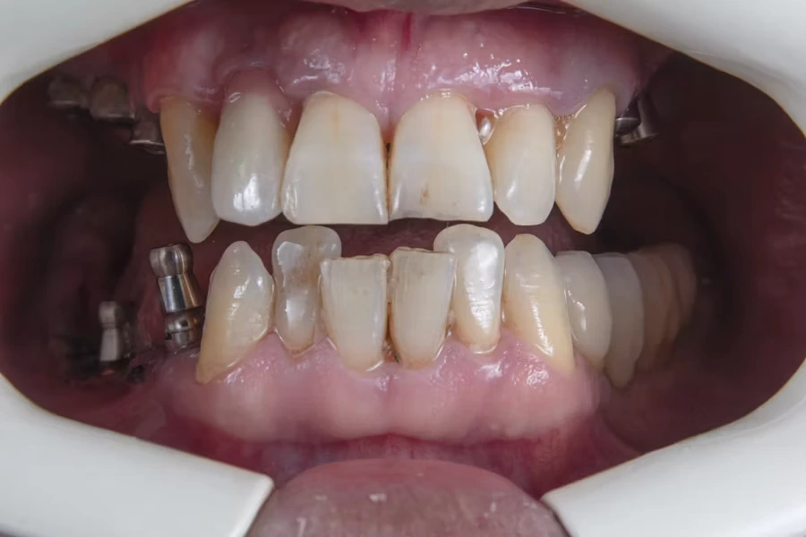Impianti dentali senza viti alternative