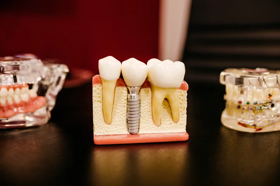 Impianto dentale Manfredonia - Studio Dr. Luigi di Bari