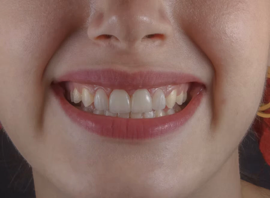 Faccette dentali ceramica composito