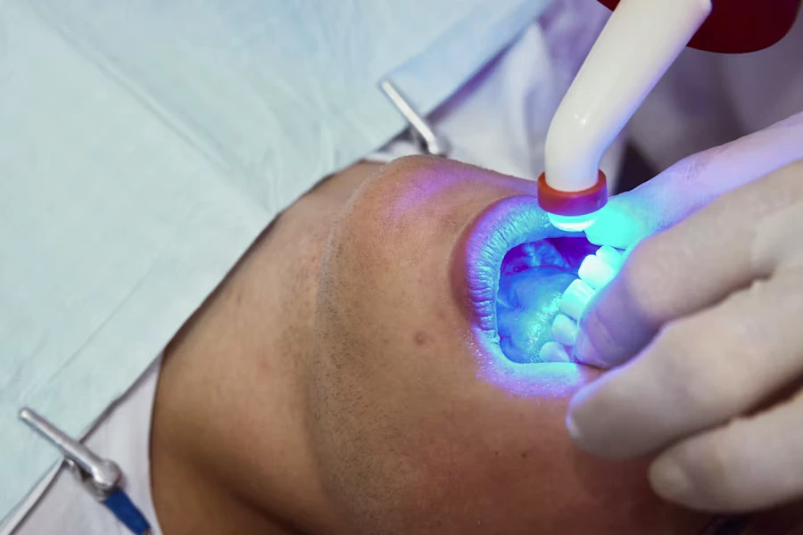 Sbiancamento dentale Manfredonia - Studio Dr. Luigi di Bari