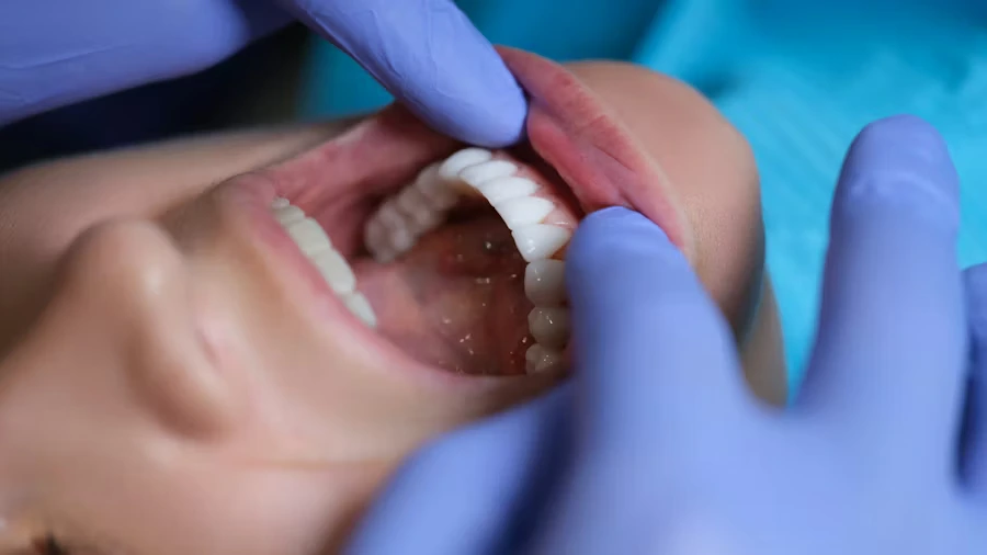 Parodontite piorrea cura - Studio Dr. Luigi di Bari Manfredonia