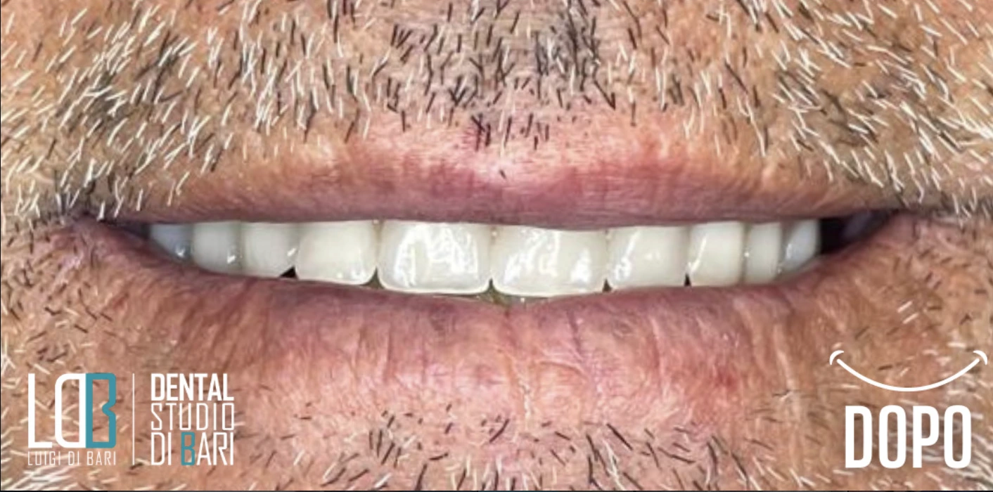 All-on-4 Manfredonia - denti fissi in un giorno su impianti in titanio