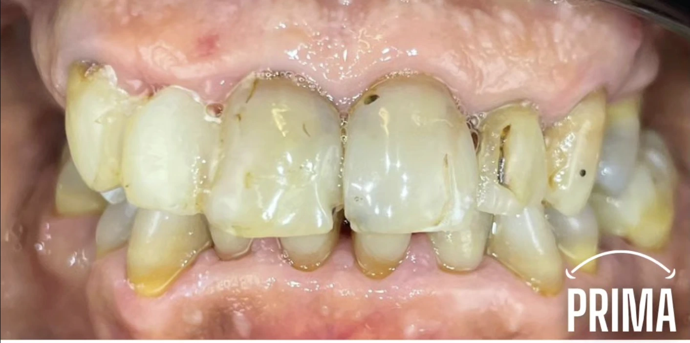 Capsule ceramica prima — denti compromessi