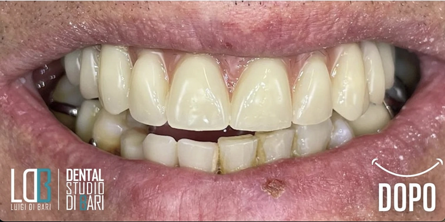 Implantologia Manfredonia - impianto singolo con corona in ceramica